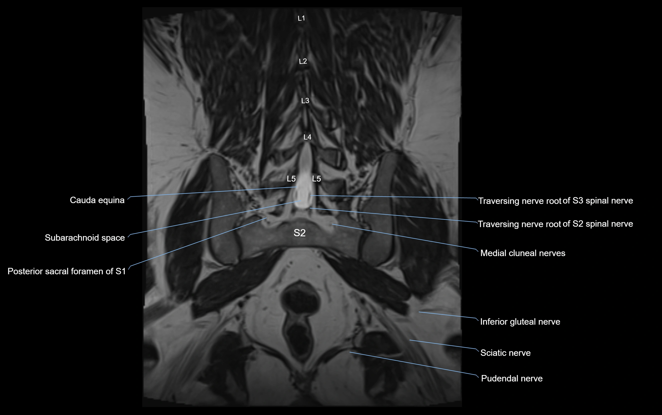 MR lumbosacral plexus cross sectional anatomy 3T  radiology  image-img-09001-00054.webp